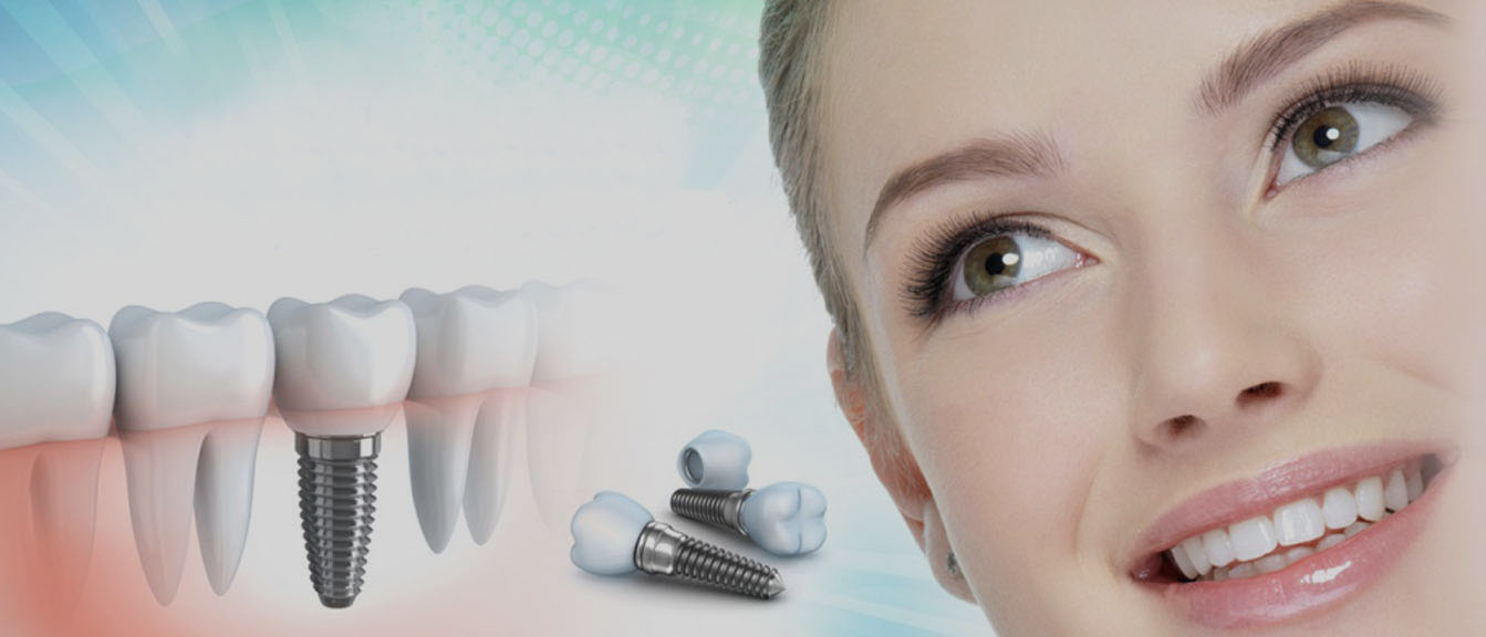 Dental implants in Bangalore