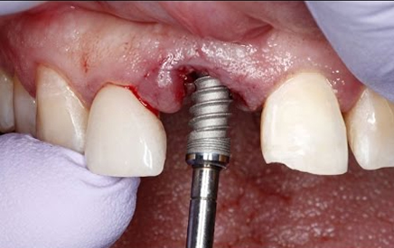 Immediate Implant Placement